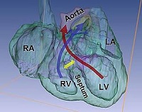 Ventricle septum defect in HeyL/1 double KO