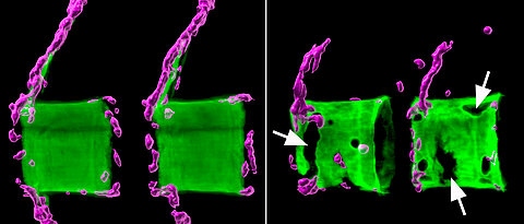 Left two healthy vertebral bodies in the spine of a medaka fish: The bone matrix (green) is normally mineralised and surrounded by bone-forming cells (magenta). On the right the situation in an osteoporotic fish.