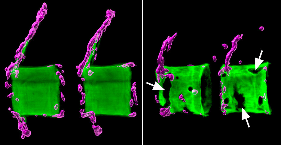 Left two healthy vertebral bodies in the spine of a medaka fish: The bone matrix (green) is normally mineralised and surrounded by bone-forming cells (magenta). On the right the situation in an osteoporotic fish.