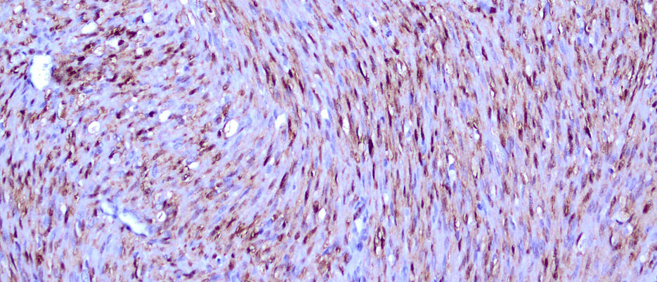 Cells of a classical mesoblastic nephroma under the microscope