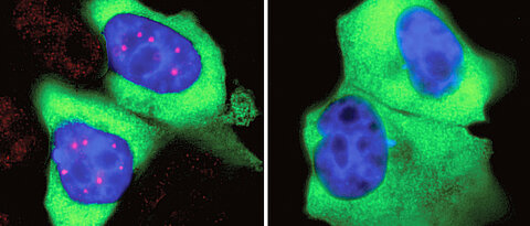 Im Zellkern menschlicher Zellen (blau) konzentriert sich SMN in den Cajal-Körpern (links, rot). Hemmt man die Phosphorylierung von SMN, unterbleibt die Konzentration und die Cajal-Körper verschwinden. 