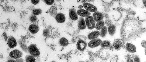Pockenviren – hier unter dem Mikroskop – zählen zu den tödlichsten Krankheitserregern der Menschheitsgeschichte. Nicht ganz so gefährlich, aber dennoch beunruhigend ist der derzeitige Ausbruch der Affenpocken. 