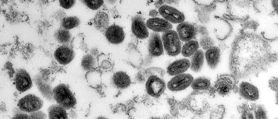Smallpox viruses - here seen under the microscope - are among the deadliest pathogens in human history. Not quite as dangerous, but still worrying, is the current outbreak of monkeypox.