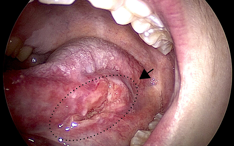 Solider Tumor (Plattenepithelkarzinom) am Zungengrund eines Patienten mit Fanconi-Anämie.