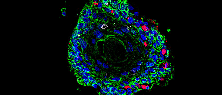Image of patient-derived ectocervical stratified squamous organoids (Green) infected with Chlamydia trachomatis (red). 